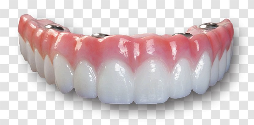 Dental Implant Bridge Dentures Dentistry All-on-4 - Zirconium Dioxide - Implants Transparent PNG