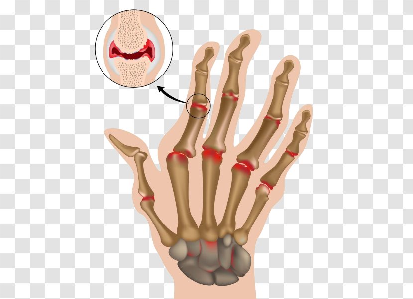 Rheumatoid Arthritis Therapy Medicine Rheumatology - Arm Transparent PNG