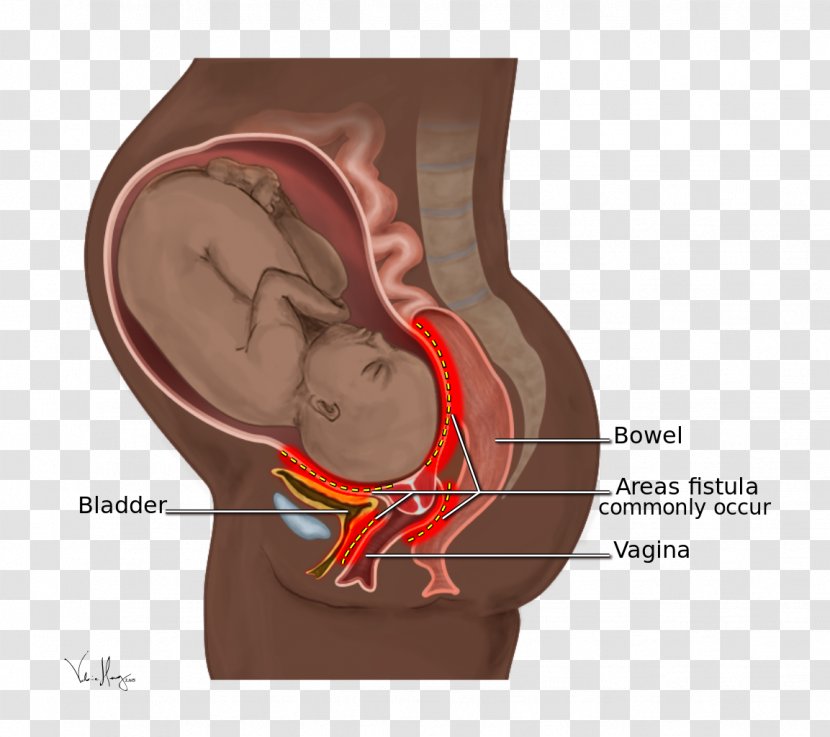 Obstetric Fistula Obstetrics Rectovaginal Childbirth - Silhouette - Day To End Transparent PNG