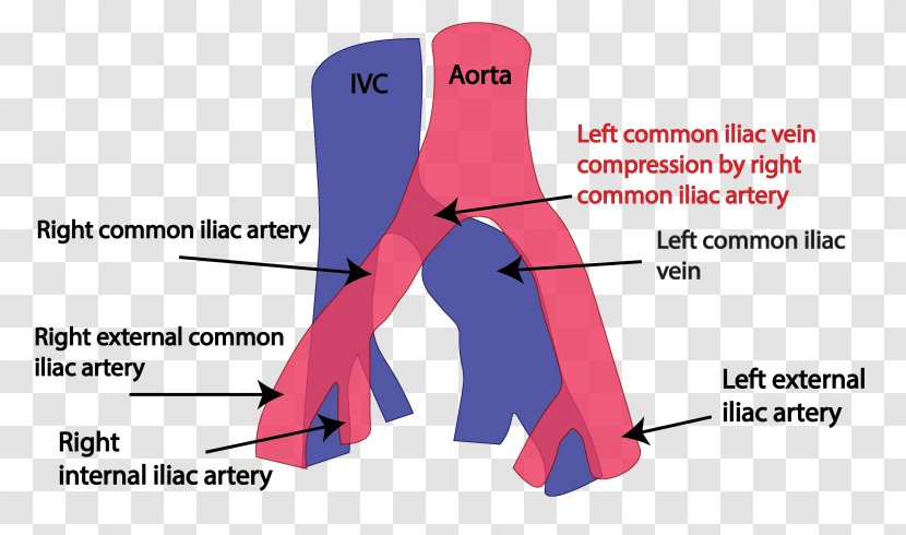 Common Iliac Vein May–Thurner Syndrome Artery Iliofemoral Ligament - Frame - Heart Transparent PNG
