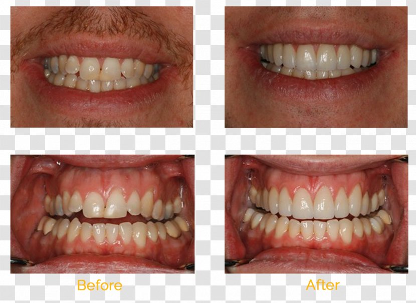 Tooth Whitening Cosmetic Dentistry Veneer - Bridge Transparent PNG