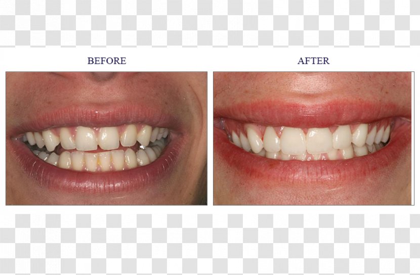 Tooth Veneer Cosmetic Dentistry Crown - Incisor Transparent PNG