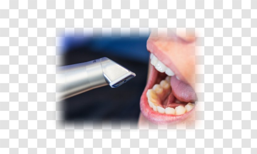 Tooth Image Scanner CAD/CAM Dentistry Escáner - Electrolysis - Moire Transparent PNG