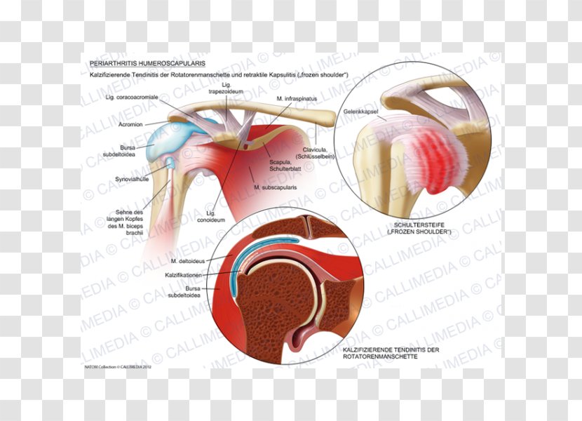 Adhesive Capsulitis Of Shoulder Periartrite Scapolo-omerale Rheumatology Joint - Cartoon - Biceps Transparent PNG