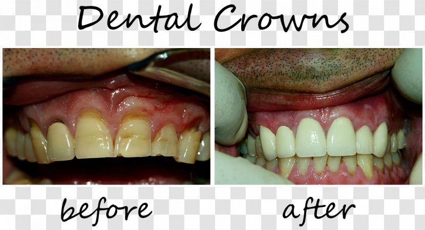 Smiles Of Cary Family Dentistry Jody Waddell DDS FAGD Tooth - Clear Aligners - Crown Transparent PNG