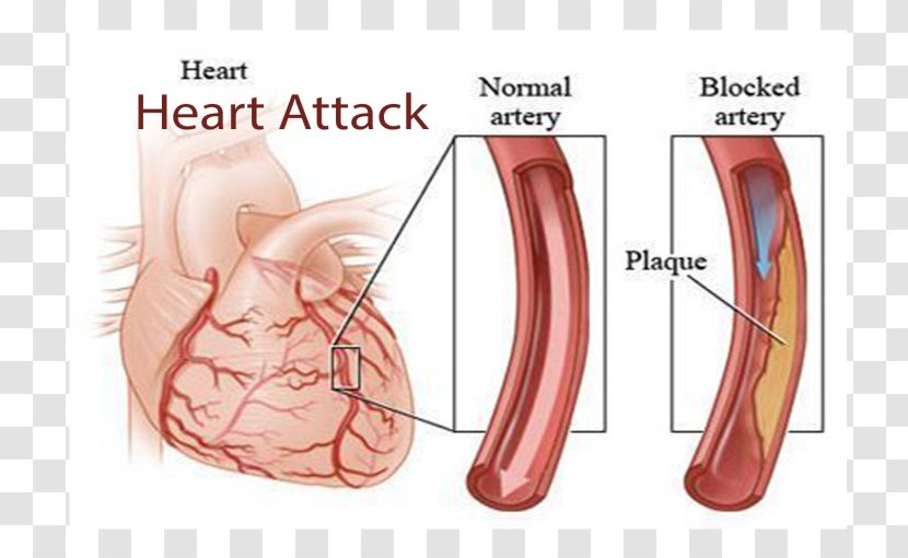 Coronary Artery Disease Arteries Cardiovascular Heart - Tree Transparent PNG