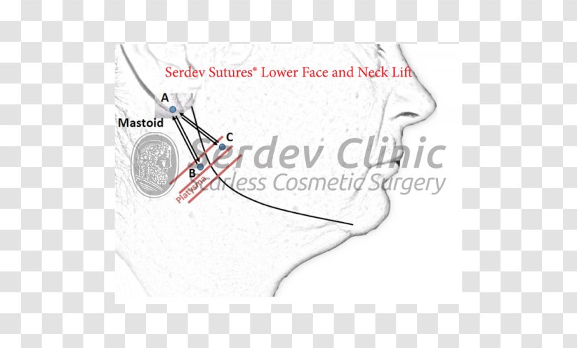 Serdev Suture Surgical Surgery Rhytidectomy Superficial Muscular Aponeurotic System - Tree - Silhouette Transparent PNG