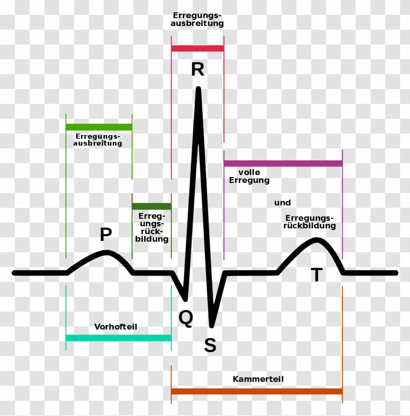 Electrocardiography Heart Arrhythmia Signal Processing Atrial Fibrillation - 3lead Ekg Transparent PNG