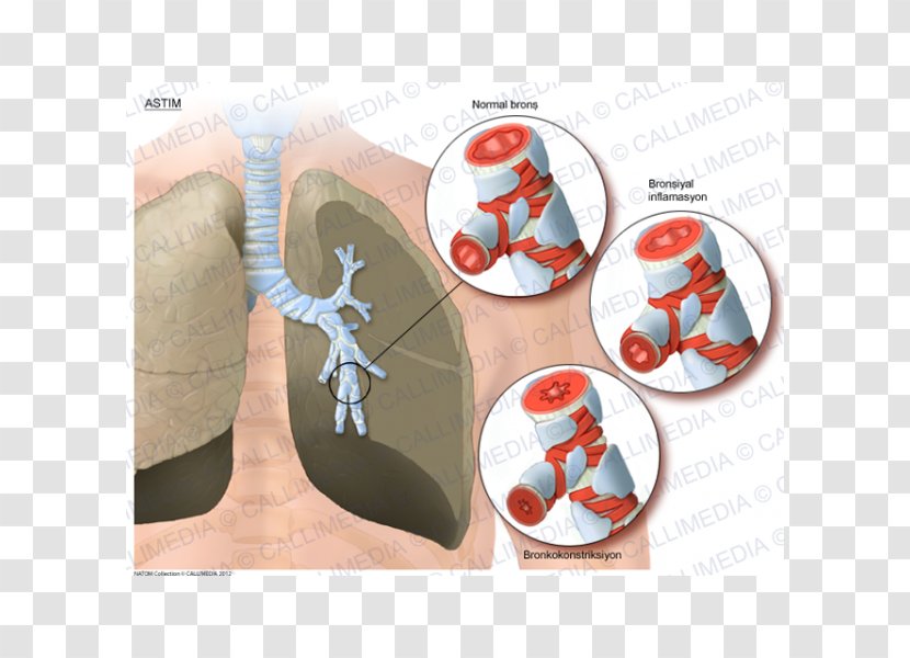 Asthma Lung Bronchus Respiratory Tract - Flower - Asma Transparent PNG