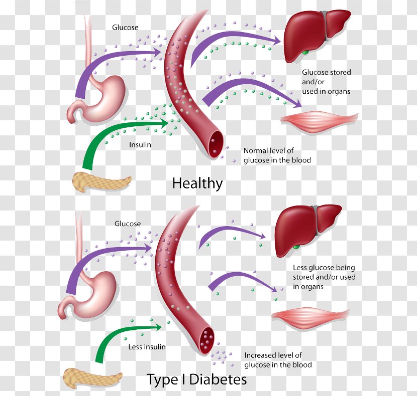 Diabetes Mellitus Type 2 1 Insulin Resistance - Flower Transparent PNG