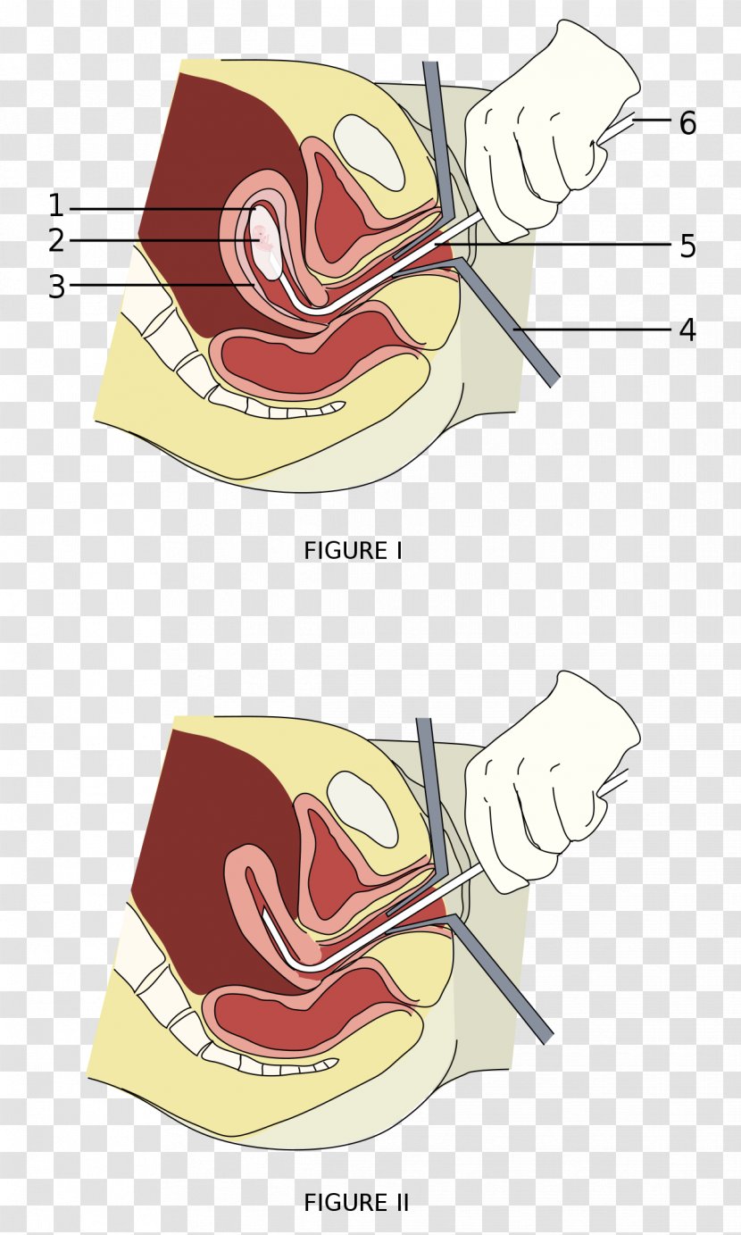 Vacuum Aspiration Surgery Abortion Miscarriage Therapy - Flower - Pregnancy Transparent PNG