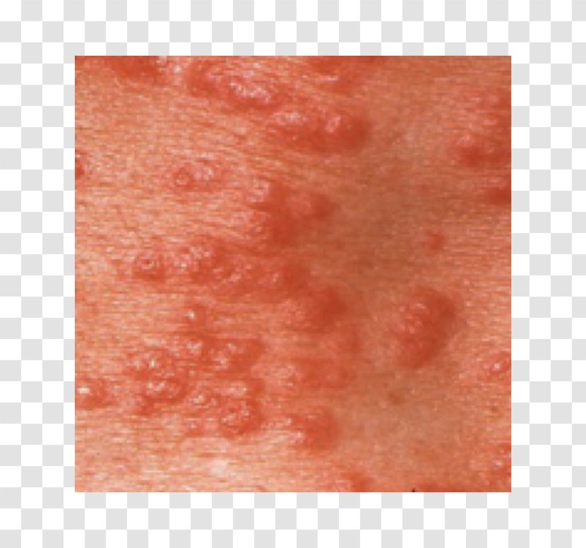Scabies Skin Rash Close-up - Tree - Red Orb Cancer Virus Cell Transparent PNG