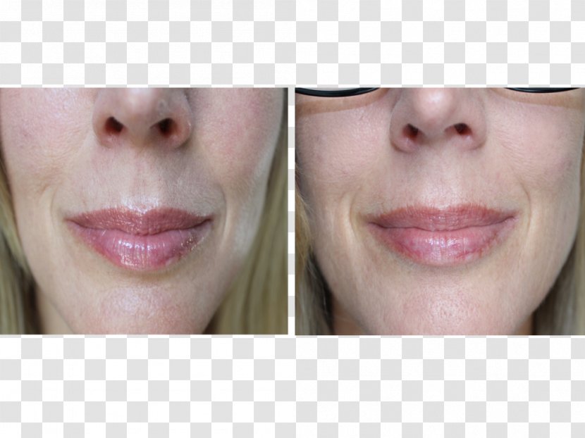 Tretinoin Lip Retinol Retinoid Wrinkle - Isotretinoin - Eye Transparent PNG