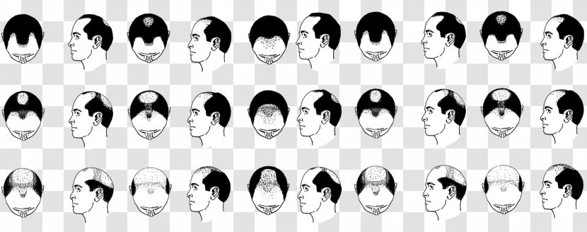 Pattern Hair Loss Transplantation Management Of Follicle Transparent PNG