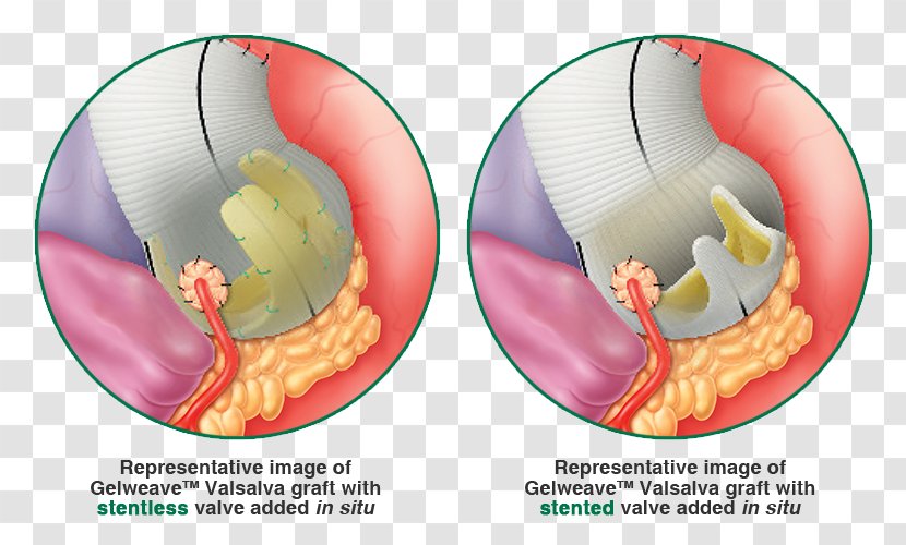 Bentall Procedure Valsalva Maneuver Valve-sparing Aortic Root Replacement Graft Sinus - Vascutek Transparent PNG