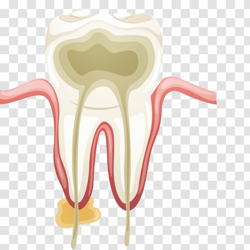 Dentistry Root Canal Tooth Endodontics Endodontic Therapy - Cartoon - Vector Art Treats Teeth Transparent PNG