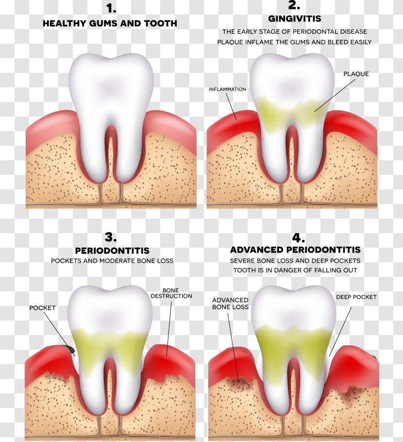 Periodontitis Disease Gums Periodontology Dentistry - Silhouette - Vector Teeth And Bad Transparent PNG