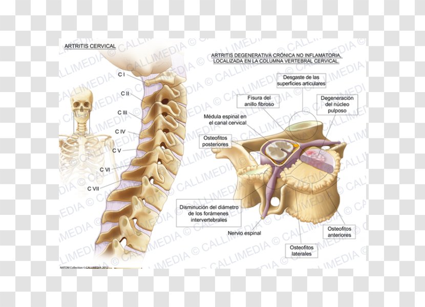 Cervical Osteoarthritis Vertebrae Vertebral Column - Cartoon - Ráº¯n 3d Transparent PNG