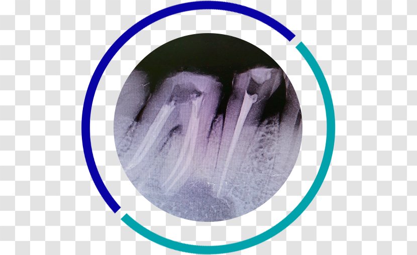 Dentistry Tooth Apicoectomy Root Canal - Dentist - Endodoncia Transparent PNG