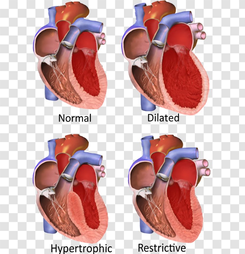 Restrictive Cardiomyopathy Dilated Hypertrophic Cardiac Muscle - Heart Transparent PNG