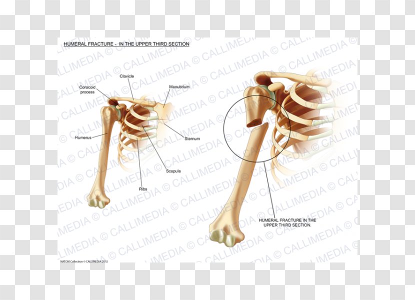 Humerus Fracture Bone Injury Sternum - Frame Transparent PNG