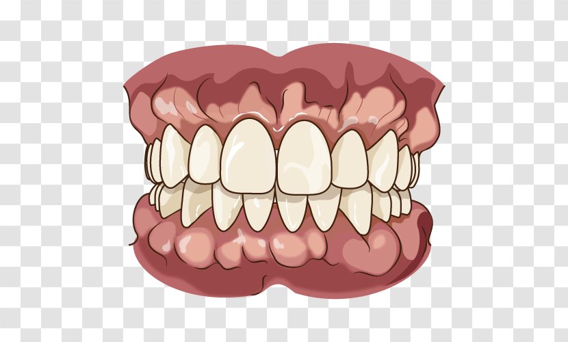 Tooth Jaw Dentures Chewing Bruxism - Frame - Alveoli Transparent PNG