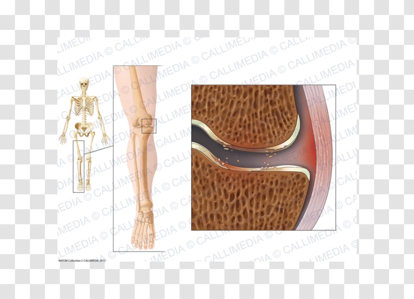 La Gonarthrose Knee Osteoarthritis Shoulder Transparent PNG