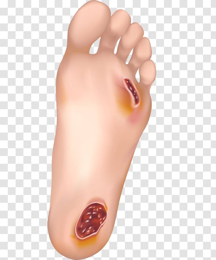 Diabetic Foot Ulcer Wound Healing Skin - Watercolor - The Dangers Of High Blood Sugar Transparent PNG