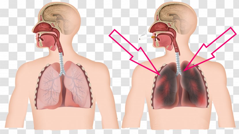 Chronic Obstructive Pulmonary Disease Tobacco Smoking Pulmonology Dyspnea - Heart - Lunges Transparent PNG