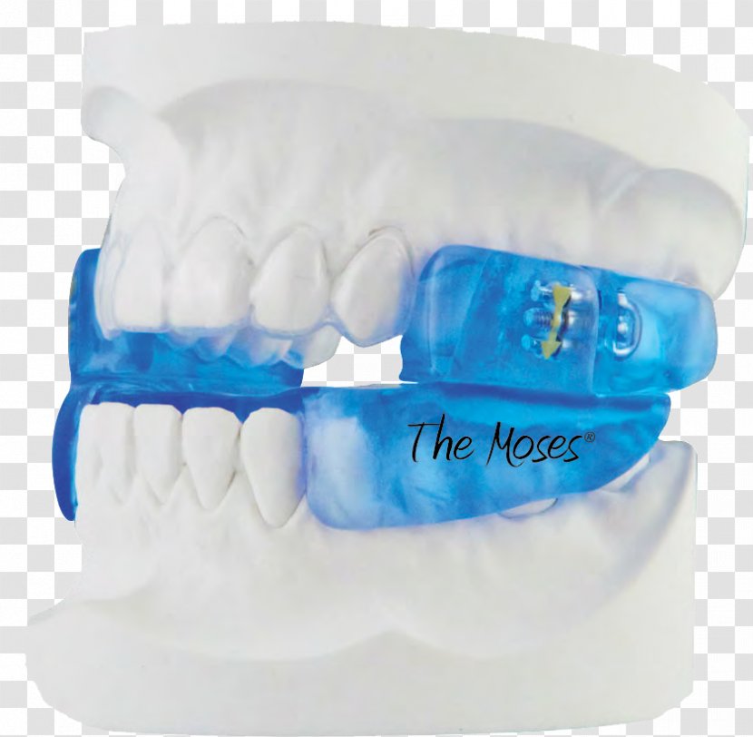 Mandibular Advancement Splint Obstructive Sleep Apnea Dentist - Jaw - Dental Architecture And Therapy Transparent PNG