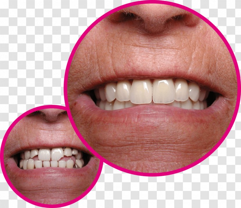 Veneer Human Tooth Gums Crown - Dental Braces Transparent PNG