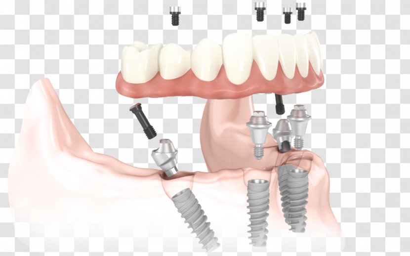 All-on-4 Dental Implant Dentistry Dentures - Denture Transparent PNG