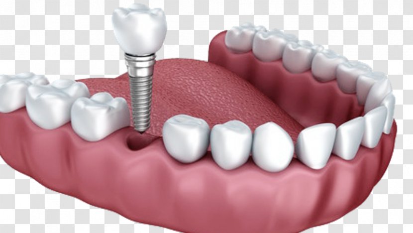 Dental Implant Dentistry Dentures - Cosmetic - Anatomy Of Teeth Transparent PNG