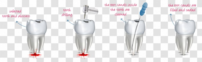Dental Mint Endodontic Therapy Root Canal Human Tooth - Tree - Decayed Transparent PNG