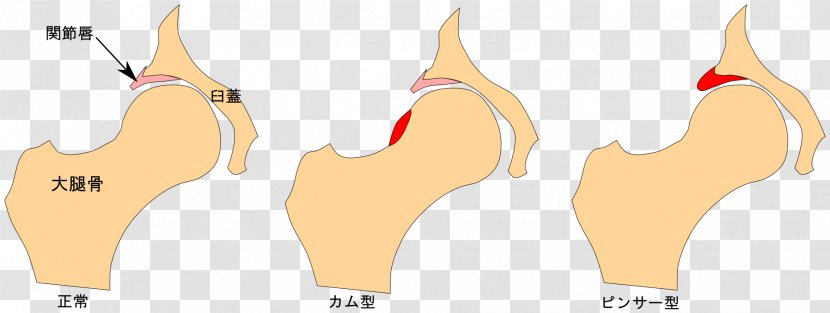 Finger Femoroacetabular Impingement Hüftgelenk Acetabulum Femur - Heart - Ace Transparent PNG