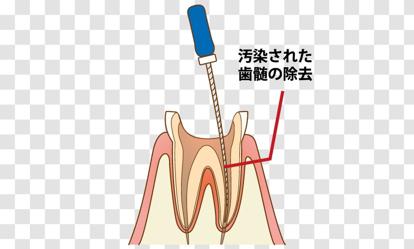 Tooth Dentist 歯科 Endodontic Therapy Root Canal - Frame - Captions Transparent PNG