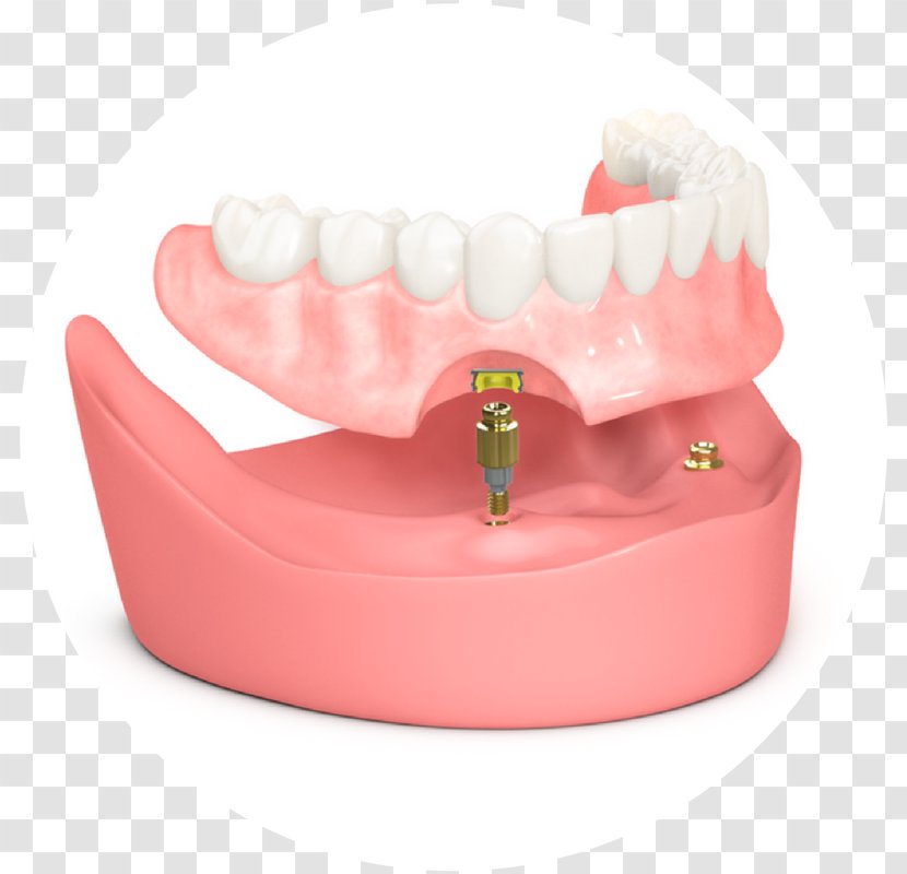Tooth Dental Implant Dentistry Dentures Prosthesis - Timonium Transparent PNG