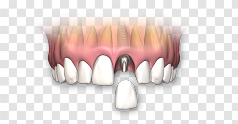 Dental Implant Dentures Dentistry Crown Human Tooth - Frame Transparent PNG