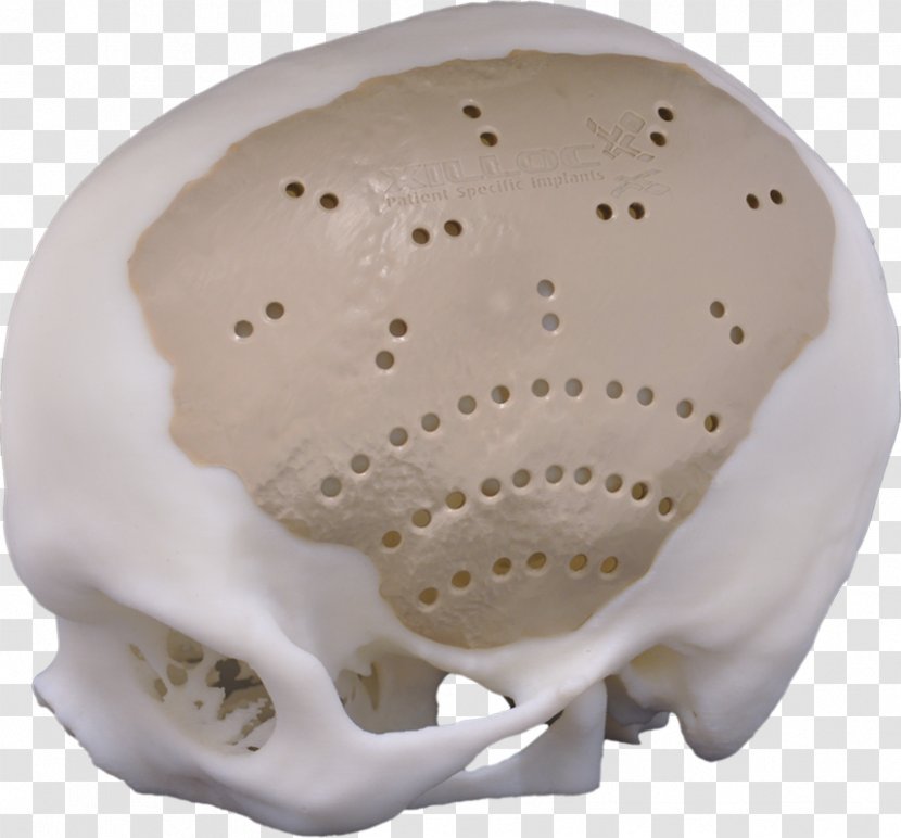 Implant Cranioplasty Polyether Ether Ketone Neurosurgery Craniotomy - Medicine - Towards The Left Transparent PNG