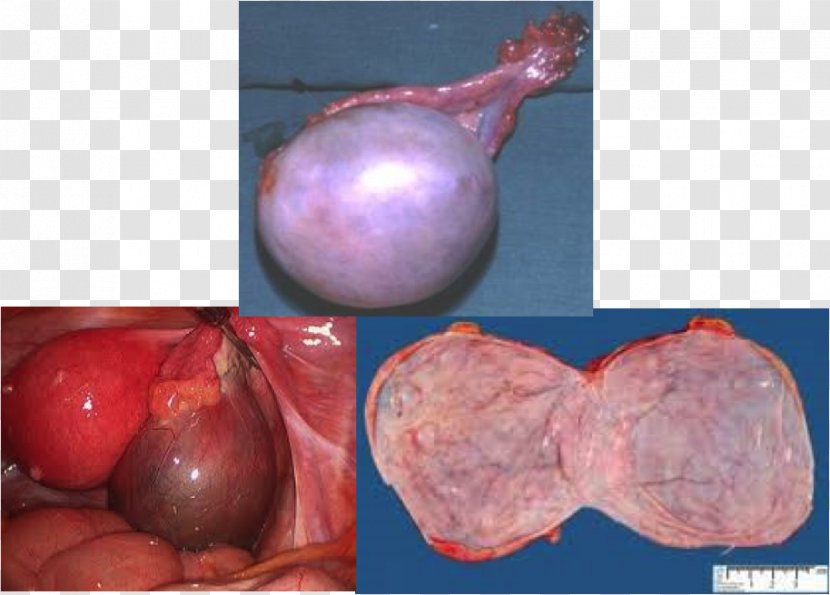 Ovarian Serous Cystadenoma Shallot - Myometrium Transparent PNG