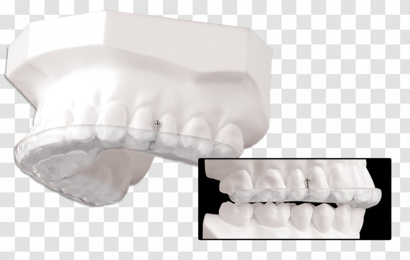 Splint Tooth Temporomandibular Joint Dysfunction Therapy Image - Jaw - Mandibular Advancement Splints Transparent PNG