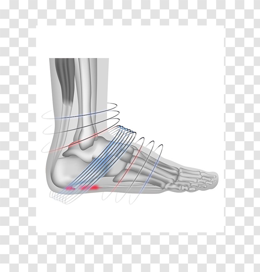 Plantar Fasciitis Extracorporeal Shockwave Therapy Fascia Foot - Tree - Cartoon Transparent PNG