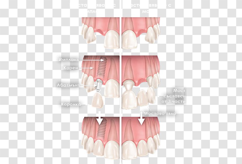 Tooth Cosmetic Dentistry Dental Implant Bruxism - Tree - Watercolor Transparent PNG