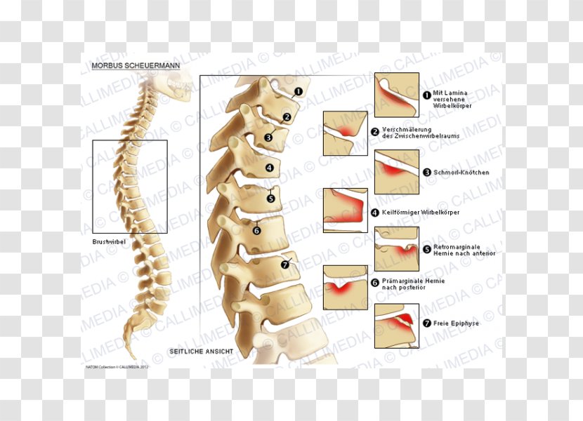Schmorl's Nodes Scheuermann's Disease Hernia Pathology - Tree - Realistic Transparent PNG