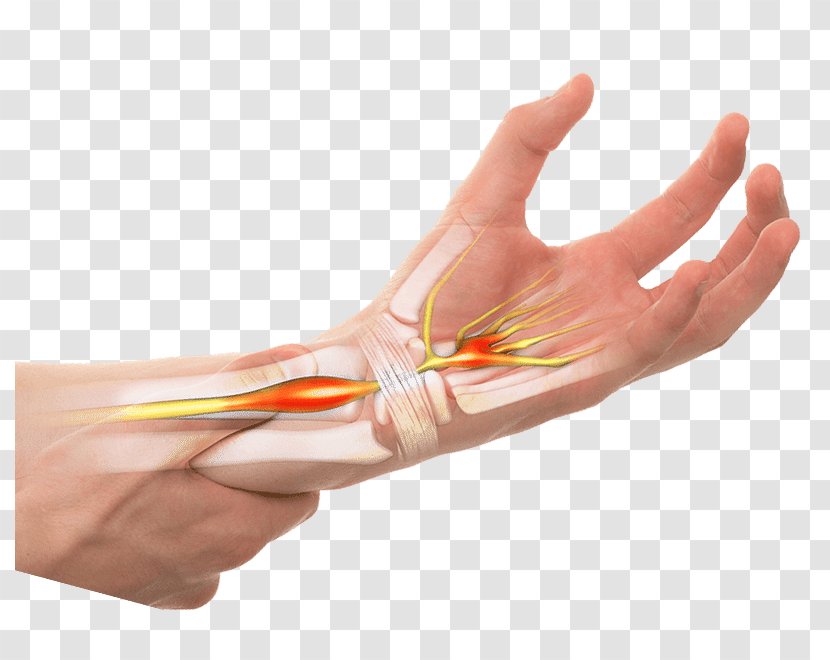 Thumb Carpal Tunnel Syndrome Symptom - Hand Transparent PNG