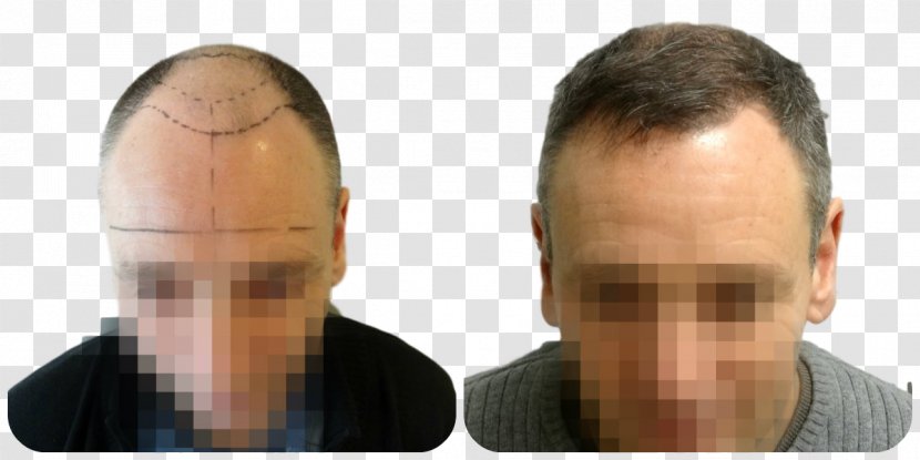 Hair Transplantation Follicular Unit Extraction Forehead Eyebrow - Therapy - Mupai Transparent PNG
