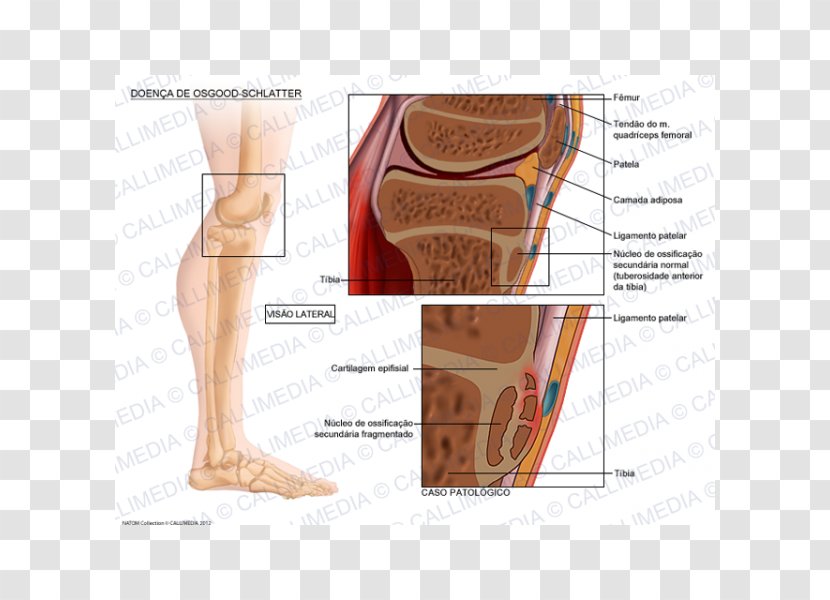 Osgood–Schlatter Disease Tuberosity Of The Tibia Growing Pains Therapy - Watercolor - Quadriceps Femoris Muscle Transparent PNG