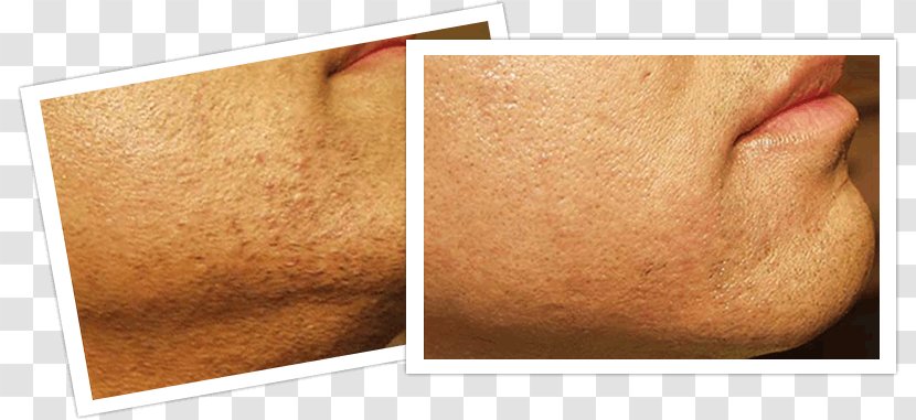 Laser Hair Removal Skin - Patient - Treatment Transparent PNG