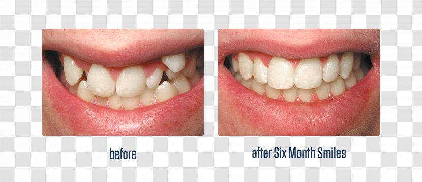Tooth Dentistry Dental Implant Retainer - Smile Transparent PNG