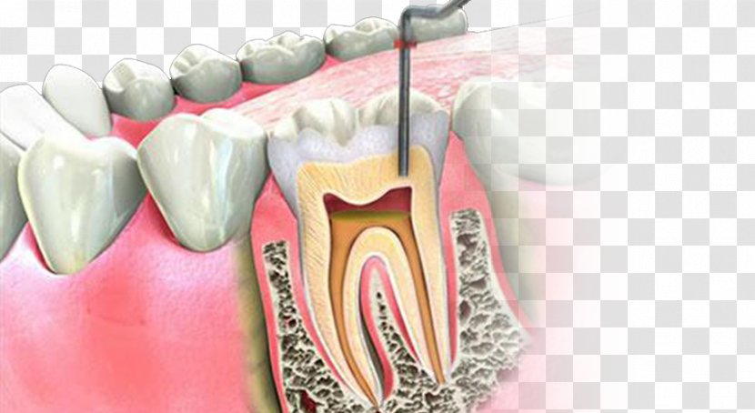 Endodontic Therapy Root Canal Endodontics Dentistry - Watercolor Transparent PNG